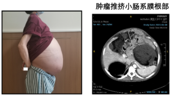 女子回国求医，上海医生历经5小时切除其腹腔25公斤肿瘤