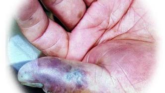 52岁杭州大伯洗小龙虾手指被刺伤，3天后多脏器衰竭离世