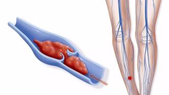 警惕“沉默的杀手”：女子自驾长途旅行后腿肿，确诊下肢静脉血栓