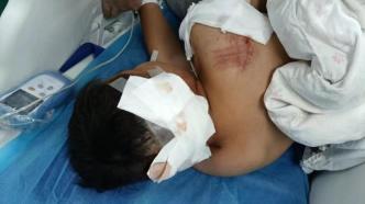 湖南10岁男童遭阿拉斯加犬咬伤，仍在ICU病房救治