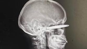 男子收鱼杆过快10厘米长铅坠插入眼眶，手术取出视力恢复