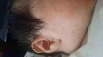 湿疹是皮肤科的“1号疾病”，儿童有10%—15%的患病率