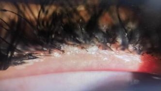 种睫毛“种”下眼疾：杭州有医院年前接诊十余例年轻女患者