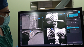 上海医生应用O型臂3D导航系统，施救3岁先天脊柱畸形患儿