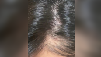 女子植发一年后“仍能清楚看到头皮”，医院拒绝退款称可补种
