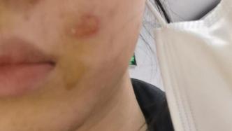 315维权丨女生光子嫩肤被烫伤，商家称赔偿需做医疗鉴定