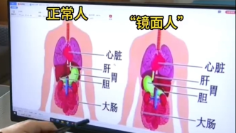 女子體檢發現自己五臟六腑全長反
