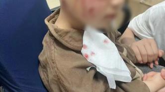 河南3岁男童被恶犬咬伤18天后离世，男童母亲发声