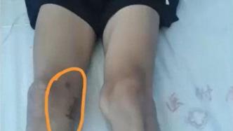 广西百色17岁体育生左膝骨瘤被错切右膝，医院6人被追责