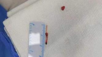 留置针头导管断在婴儿血管里随血液漂移，5年后才找到取出