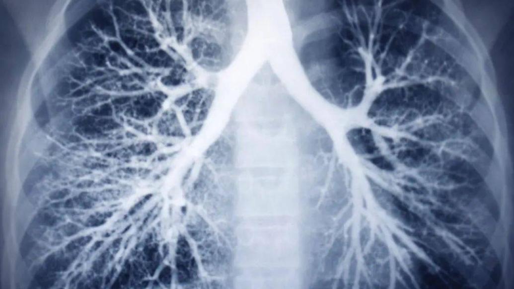 追问｜20多年来首款！慢阻肺治疗领域迎来全新机制药物
