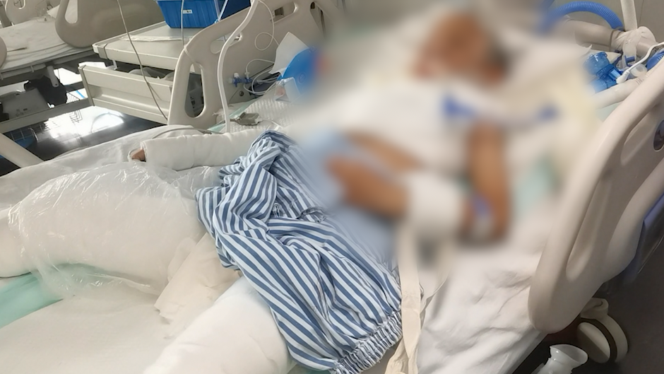 7歲男孩“燒烤”被飛濺酒精嚴重燒傷,尚未脫離生命危險