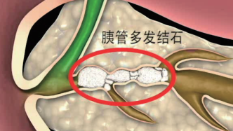 消化道里的“世界难题”