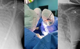 对话全球首例老年新冠肺移植手术主刀医生