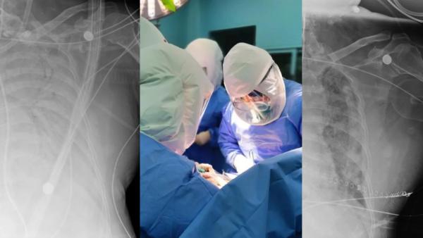 对话全球首例老年新冠肺移植手术主刀医生