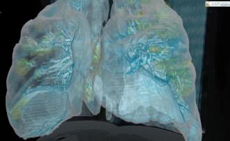 新冠肺部感染模拟视频：损伤或不可逆