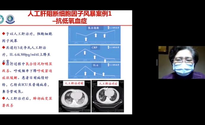 李兰娟：人工肝血液净化可治新冠危重症