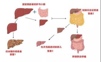 全球首例多米诺肝移植联合小肠移植术：受体肝脏再作供肝移植