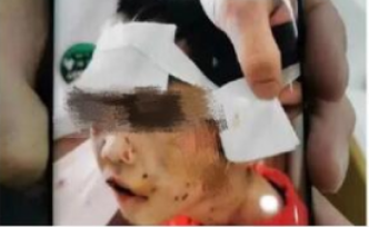 黑龙江省妇联介入四岁女童被虐打重伤事件：权益部正开展工作