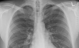 欧洲首例：维也纳医院成功对新冠肺炎患者实施肺移植手术