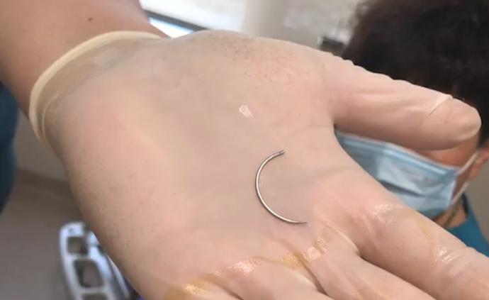 分娩5月后縫合處取出2cm彎針，醫院：退費并對助產士停職