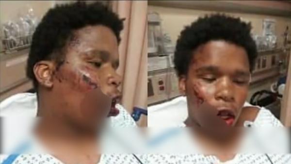 纽约16岁少年抗议期间遭警察电击毁容，警方称其纵火