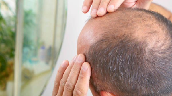 美国大学研究：秃顶男性或更容易感染新冠