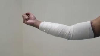 视频丨港警露遭暴徒强酸灼伤手臂，力挺香港国安法