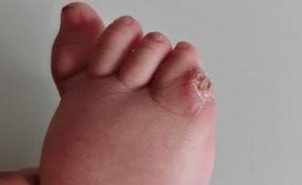 邯郸一幼儿小脚趾畸形，医生手术失误致小脚趾全部被切掉