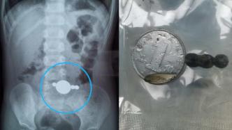 2岁女童误吞硬币与磁力球，五处肠穿孔被送入ICU