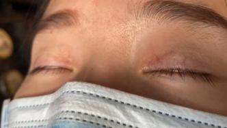 做双眼皮手术一年后仍无法正常闭眼，主治医生：个人感觉