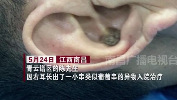 怪事男子耳朵竟长出了葡萄串